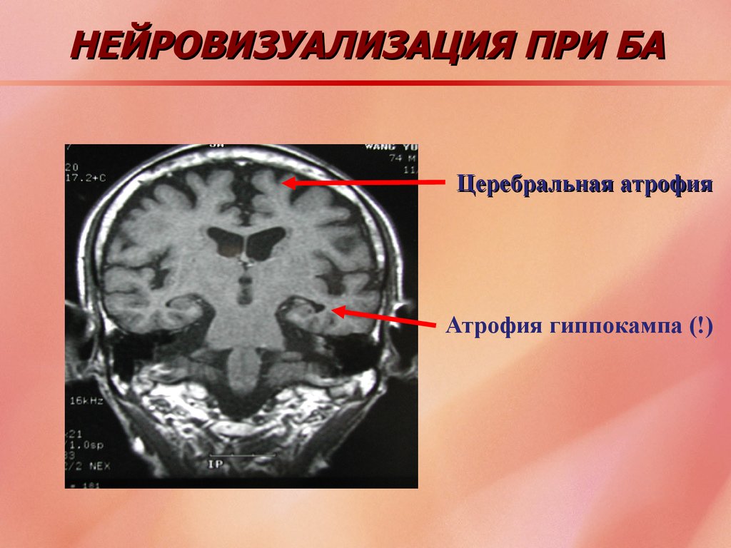 Атрофия мозга симптомы. Атрофия гиппокампа на мрт. Болезнь Альцгеймера мрт. Атрофия гиппокампа при болезни Альцгеймера. Мрт головного мозга при болезни Альцгеймера.