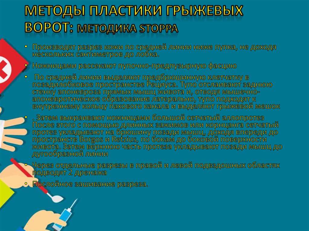 Методы пластики грыжевых ворот: методика Stoppa