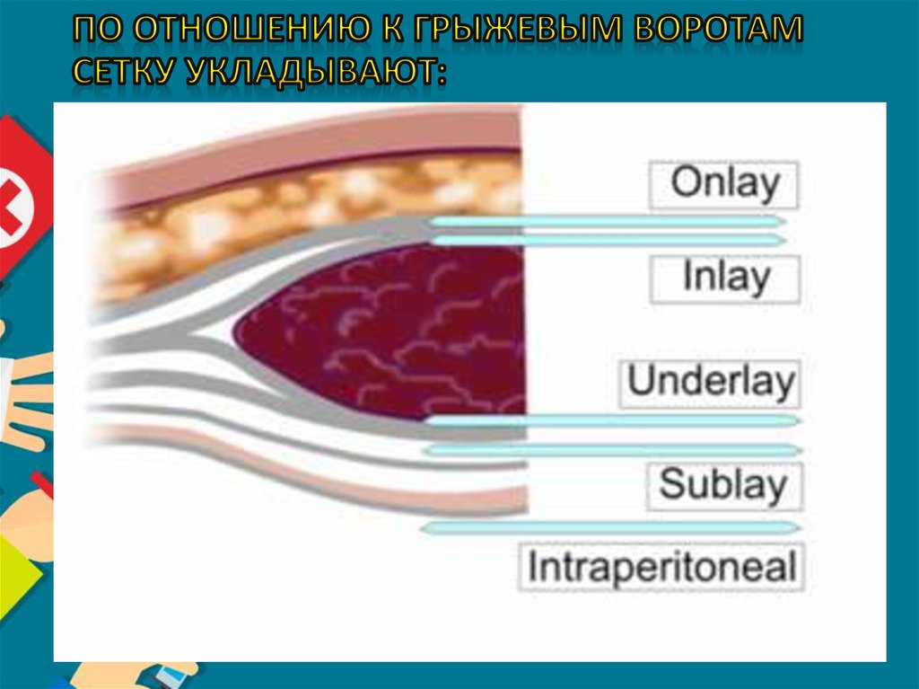по отношению к грыжевым воротам сетку укладывают: