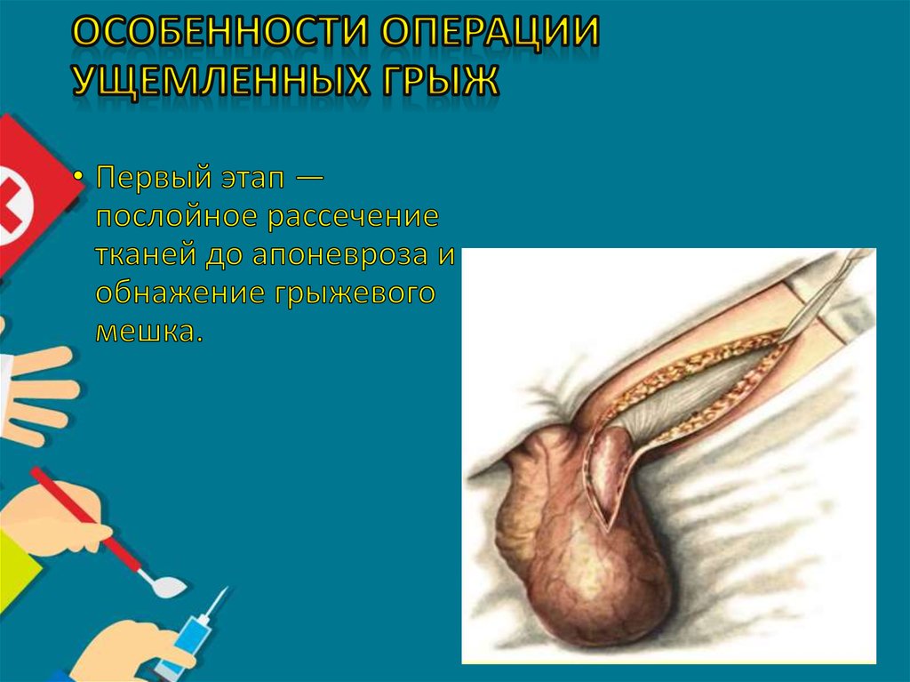 Особенности операции ущемленных грыж