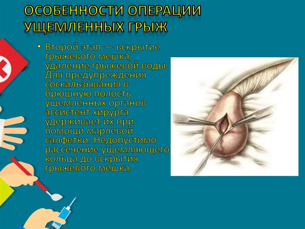 Особенности операции ущемленных грыж