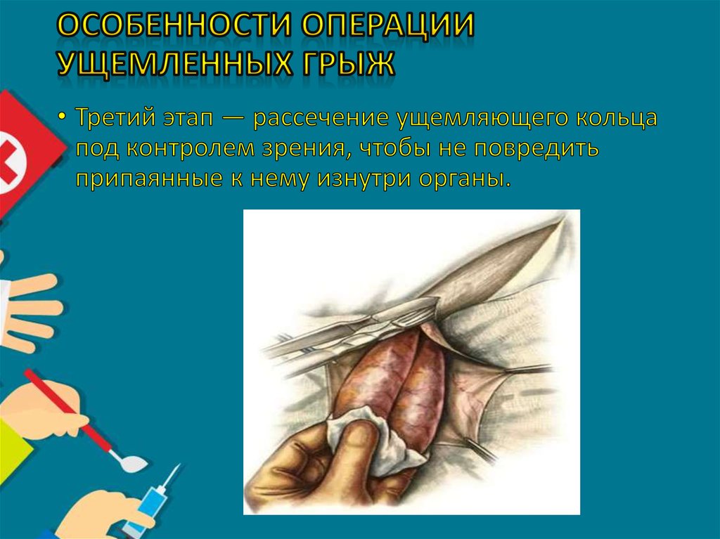 Особенности операции ущемленных грыж