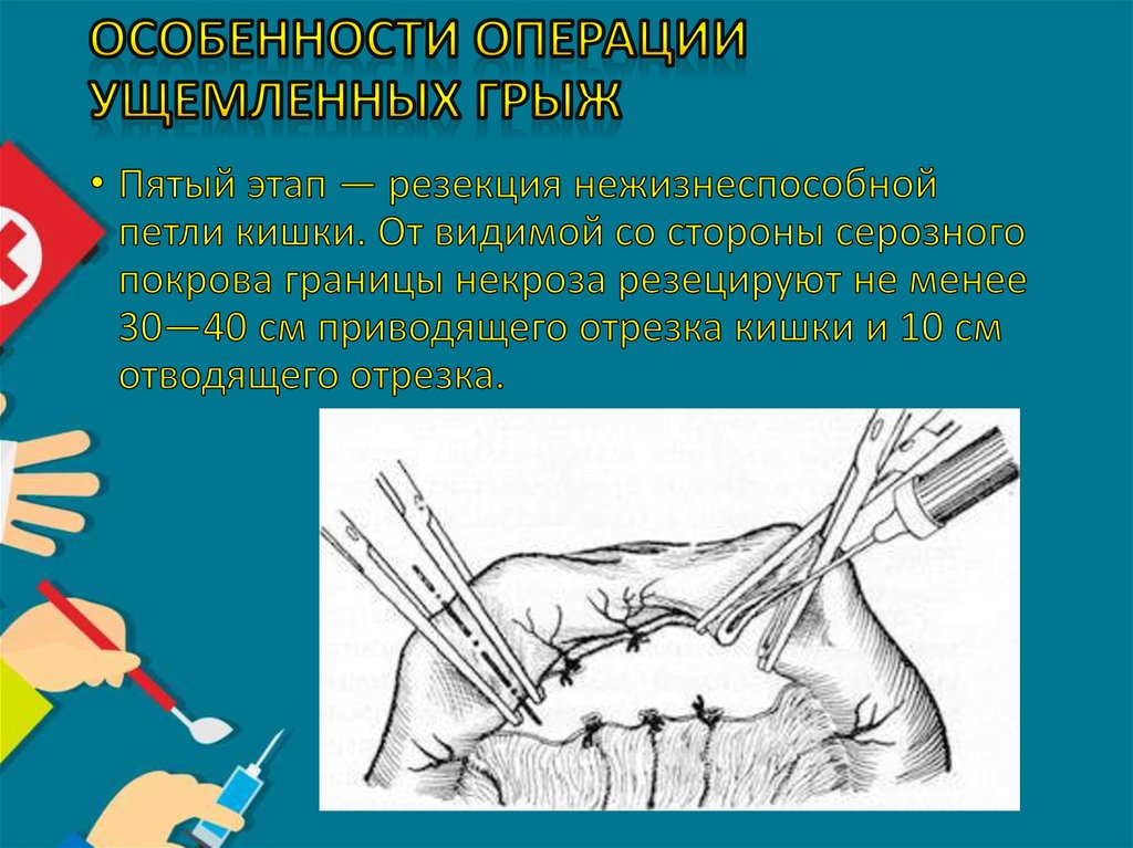 Особенности операции ущемленных грыж