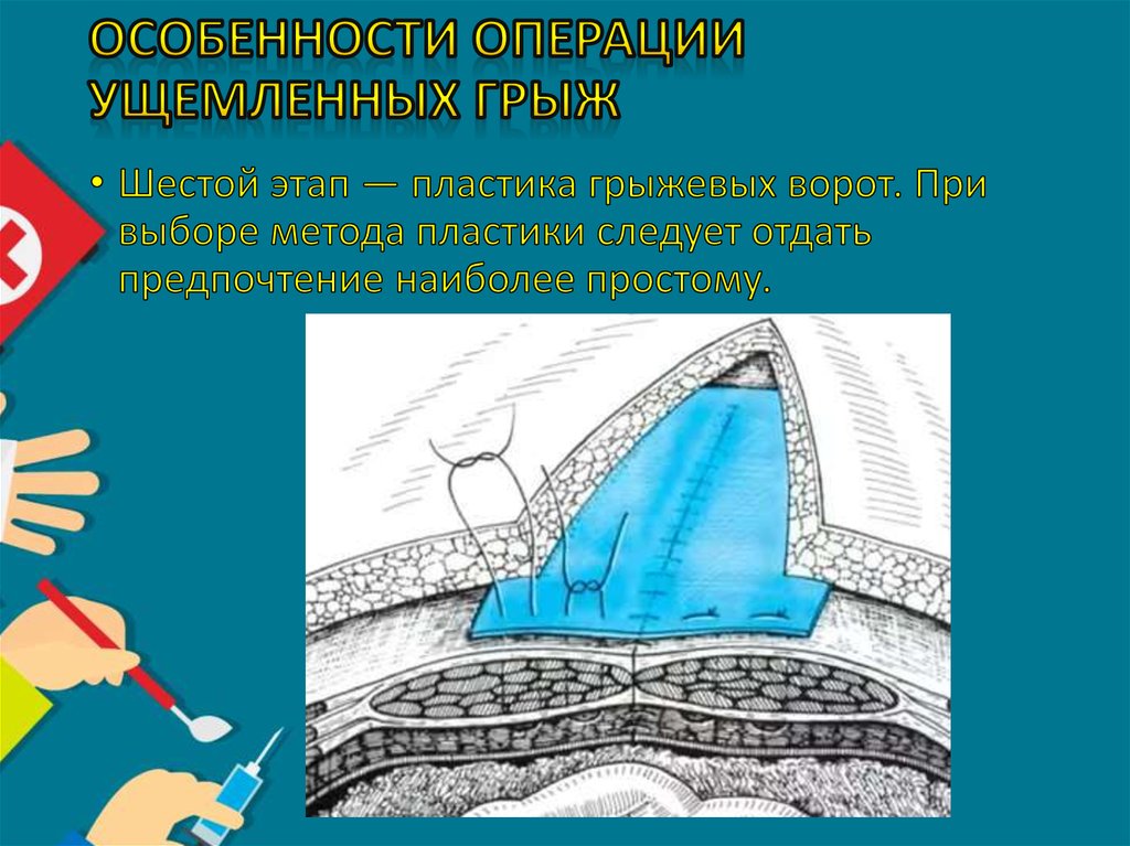 Особенности операции ущемленных грыж