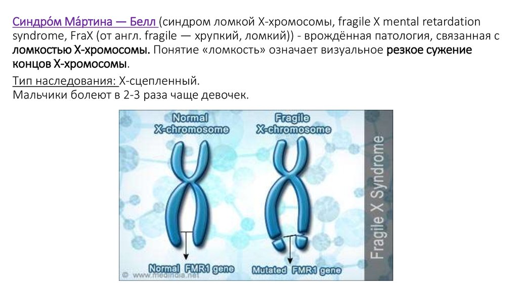 Синдром мартина белла презентация