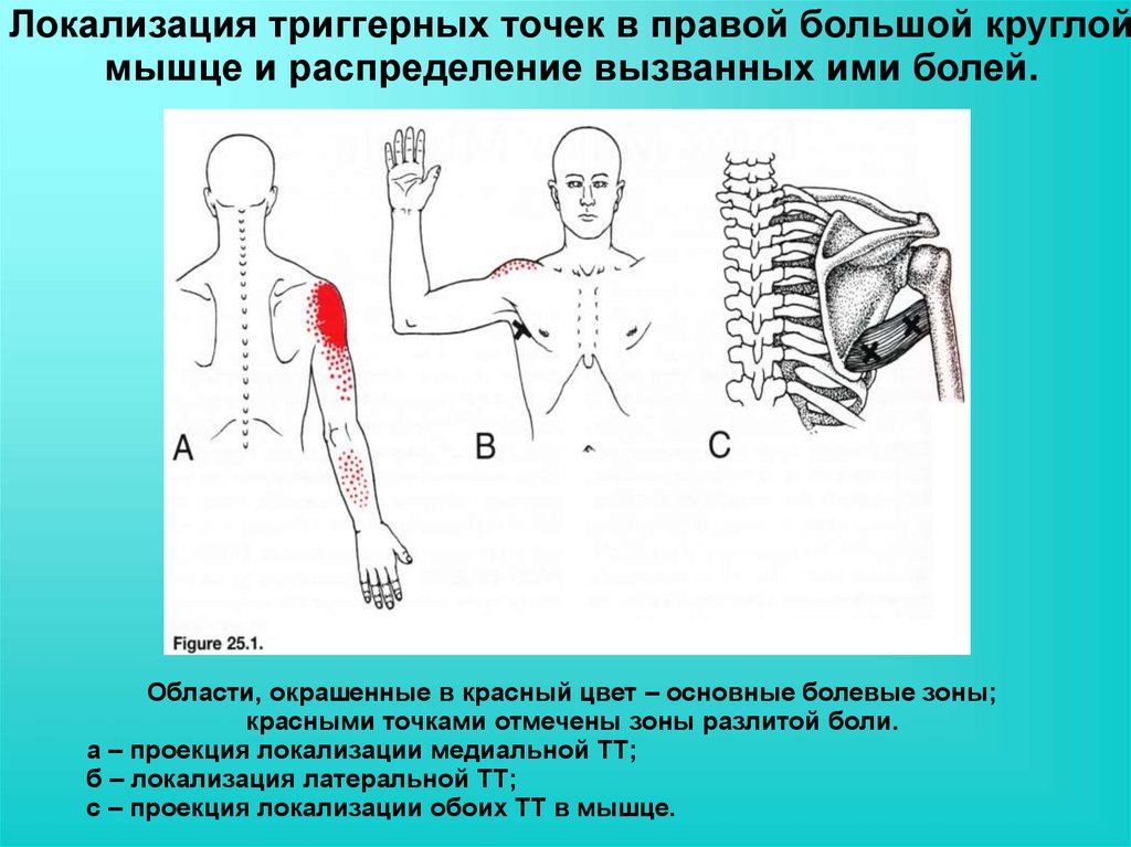 Лечение триггерных точек в мышцах