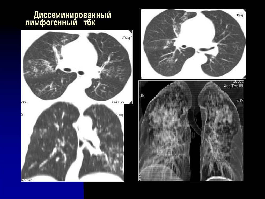 Картина кт при туберкулезе