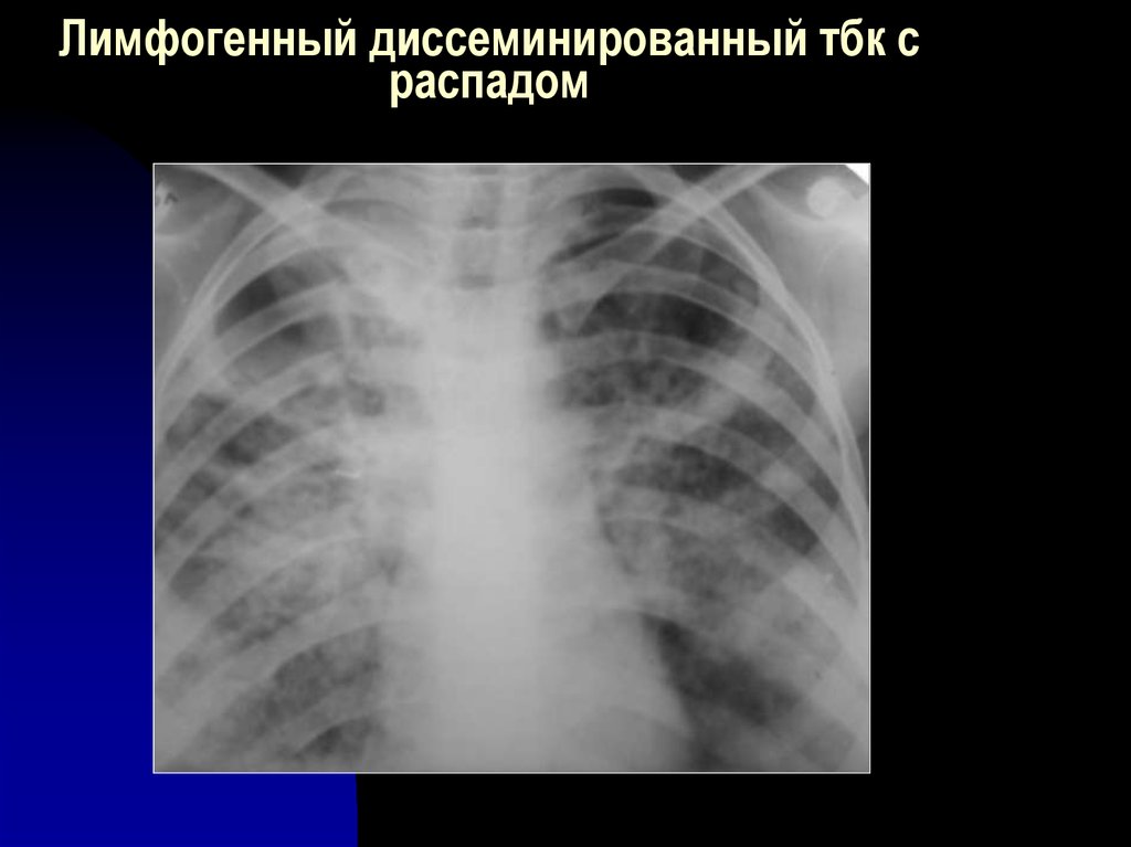 Лимфогенный туберкулез. Лимфогенный диссеминированный туберкулез. Лимфогенный диссеминированный туберкулез легких это. Лимфогенная диссеминация при туберкулезе. Лимфогенный туберкулез легких на кт.