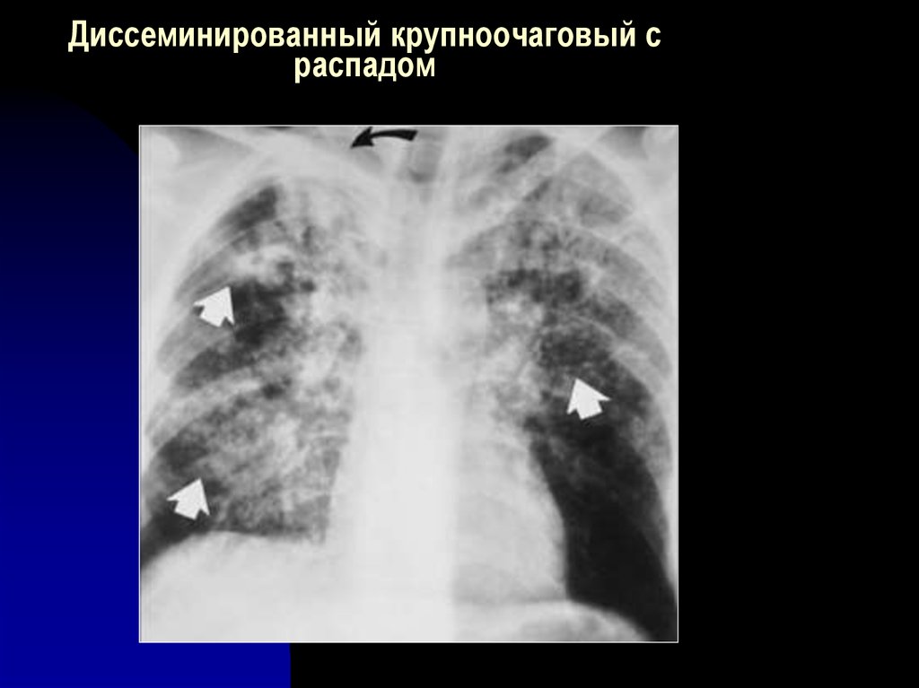 Инфильтративный распад легких. Подострый диссеминированный туберкулез рентген. Диссеминированный туберкулез в фазе распада. Хронический диссеминированный туберкулез рентген. Диссеминированный инфильтративный туберкулез.