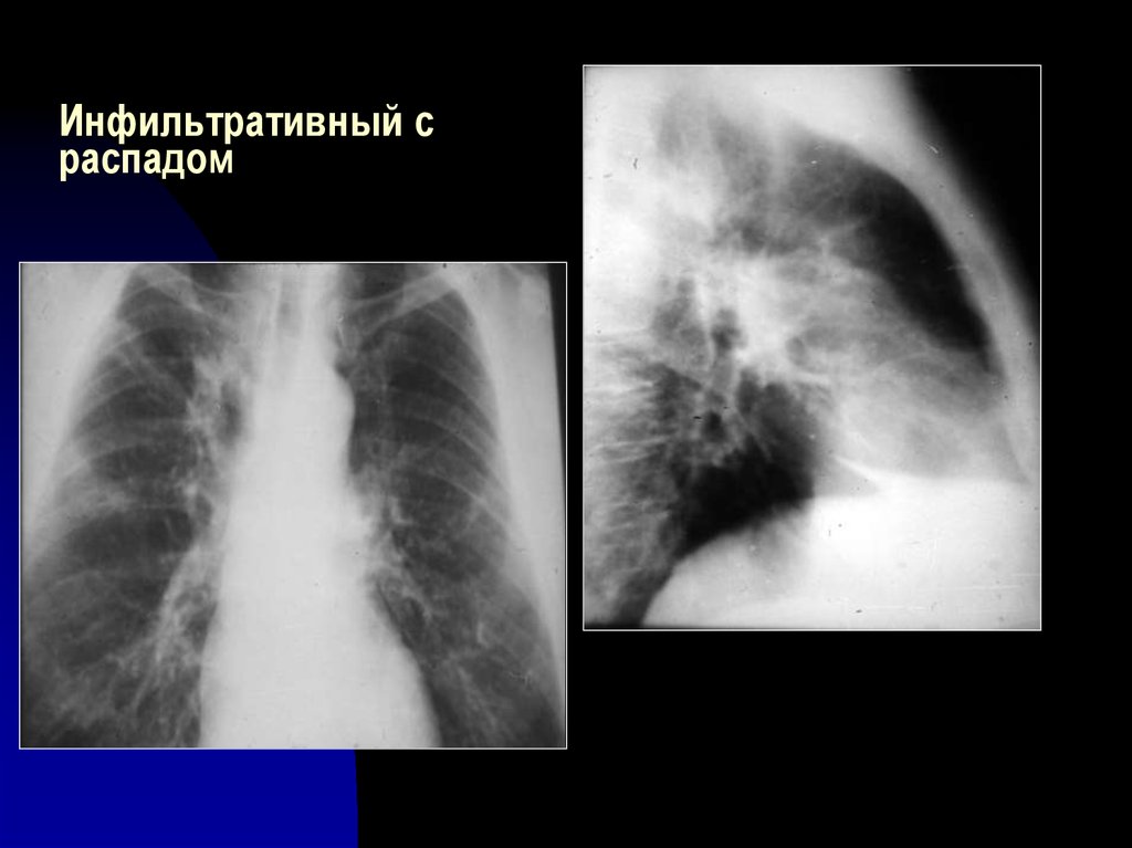 Инфильтративный распад легких. Инфильтративный туберкулез в фазе инфильтрации. Инфильтративный туберкулез с распадом. Инфильтративный туберкулез фаза обсеменения.