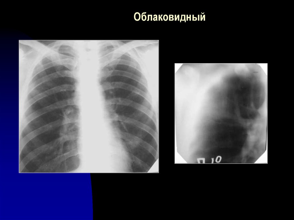 Перисциссурит рентген картина