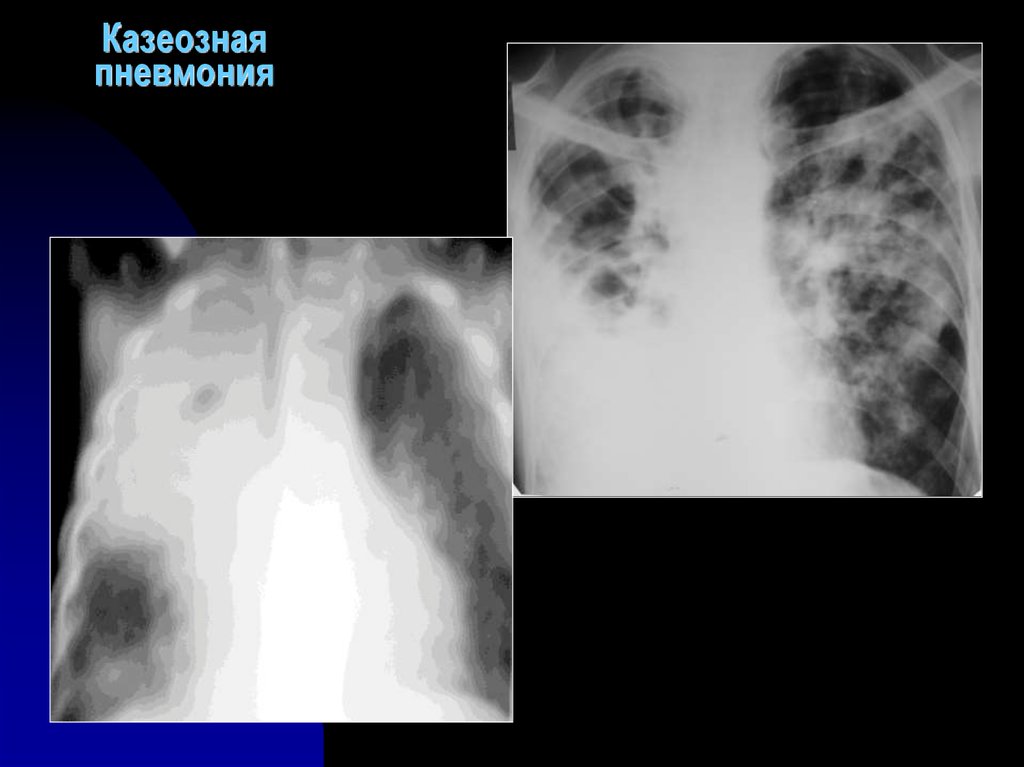 Казеозная пневмония презентация