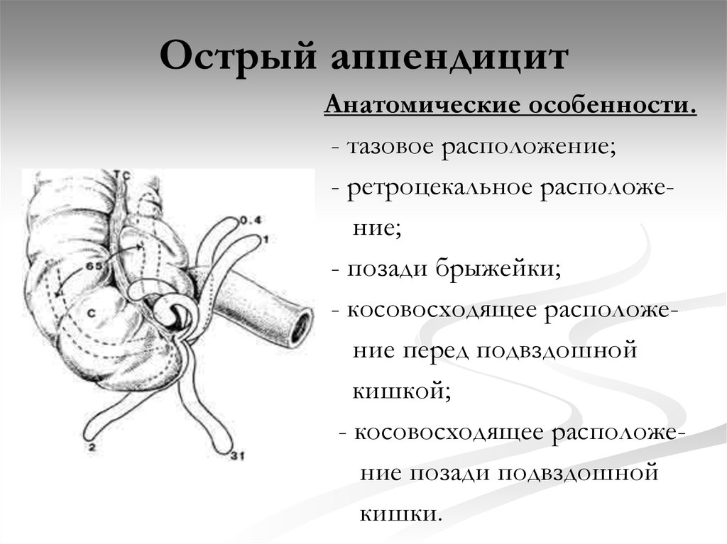 Особенности клинической картины острого аппендицита при тазовом расположении червеобразного отростка