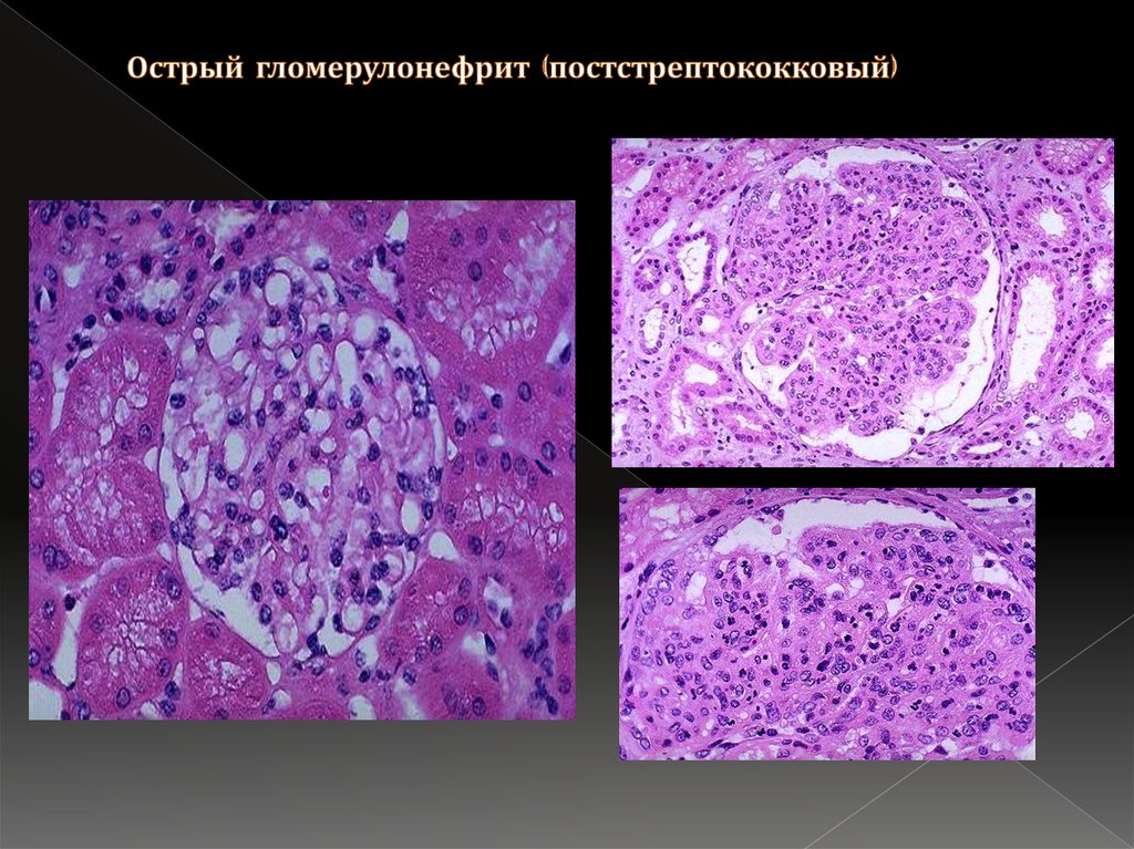 Морфологическая картина гломерулонефрита