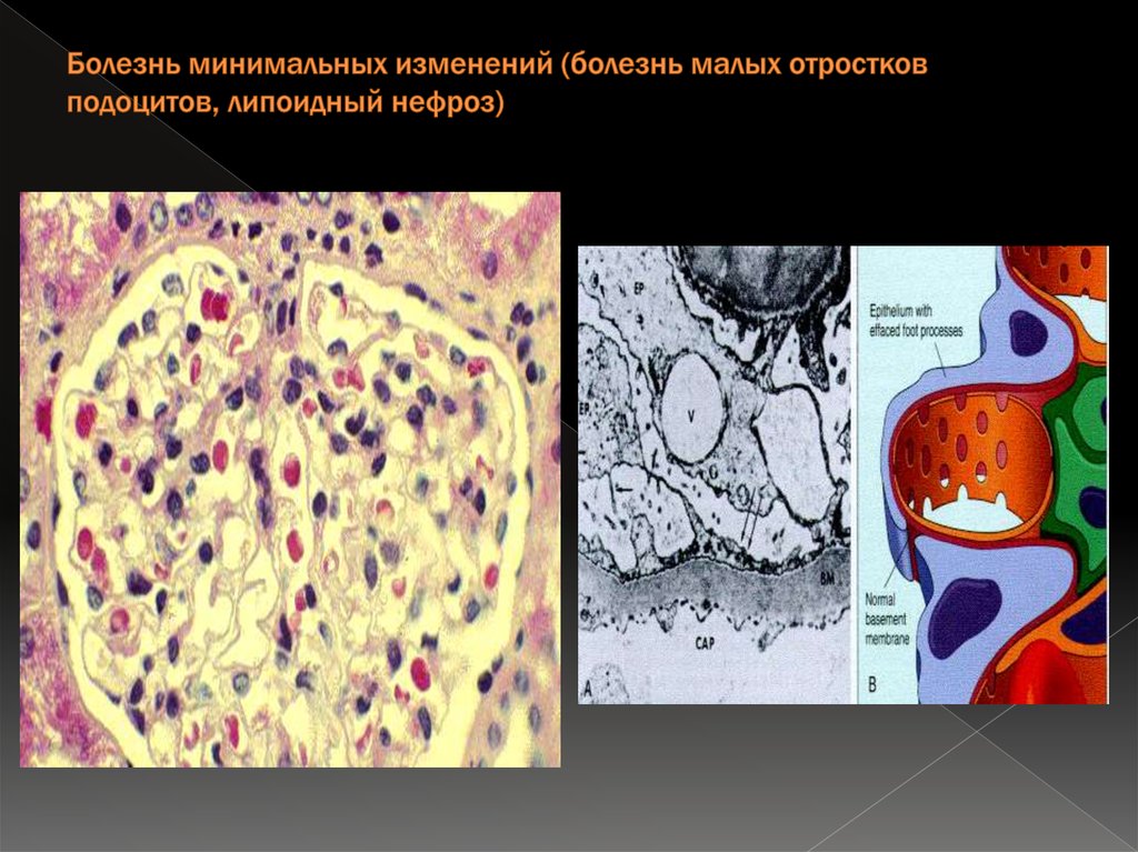 Заболевания изменения. Минимальные изменения клубочков (липоидный нефроз);. Болезнь малых ножек подоцитов. Болезнь малых отростков подоцитов. Болезнь минимальных изменений липоидный нефроз.