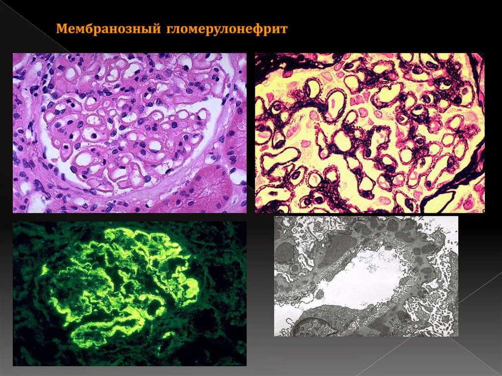 Патанатомия это. Хронический мембранозный нефрит. Мембранозный гломерулонефрит патанатомия. Гломерулонефрит патанатомия. Гломерулонефрит патологическая анатомия.