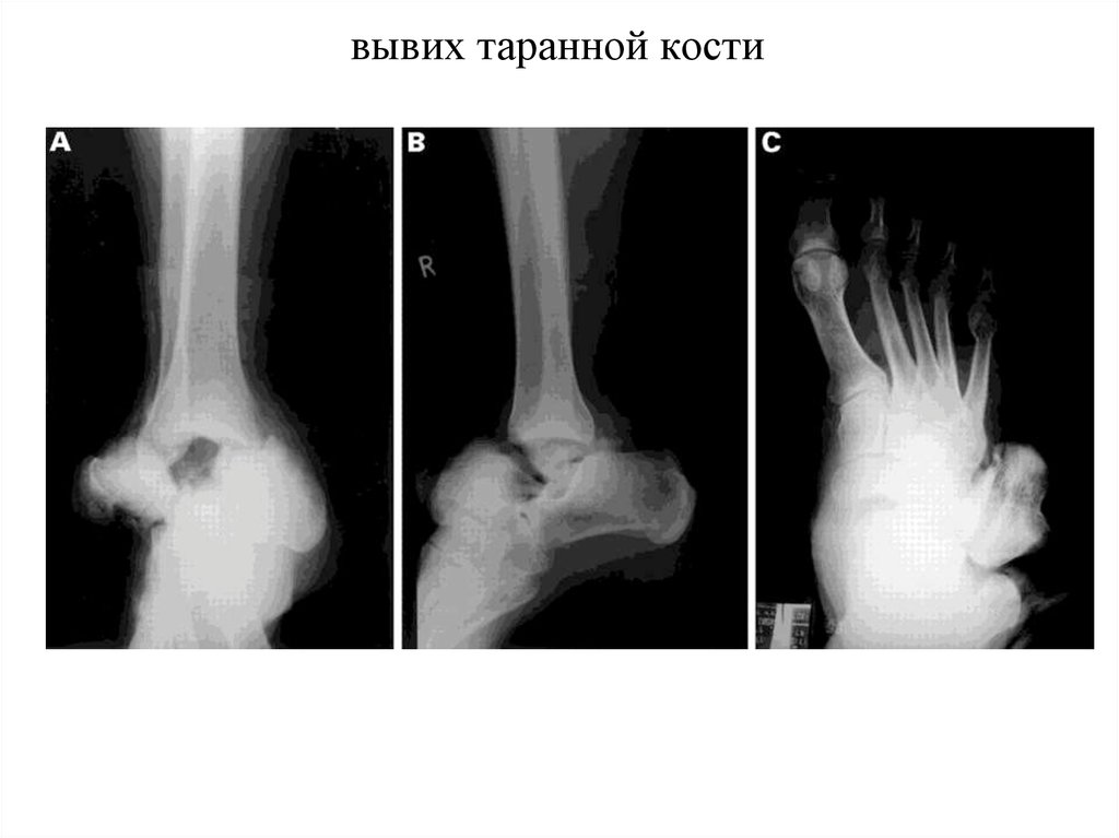 Смещение кости на ноге