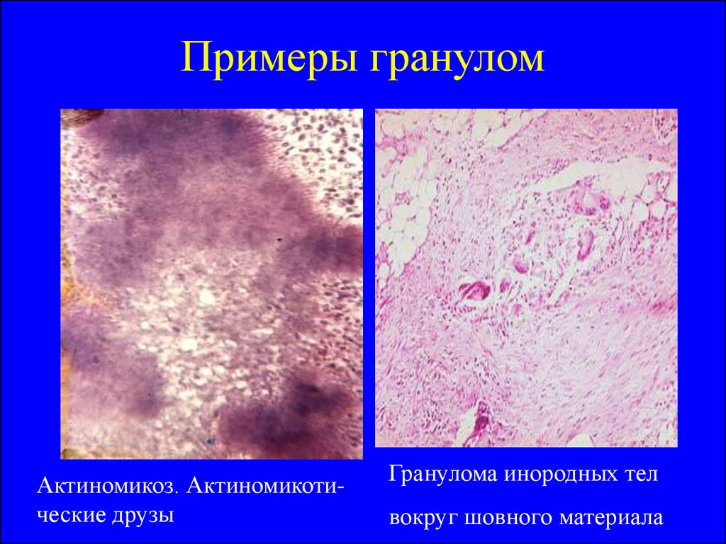 Воспаление вокруг. Гранулема инородного тела микропрепарат. Актиномикоз микропрепарат. Гранулема вокруг инородного тела микропрепарат.