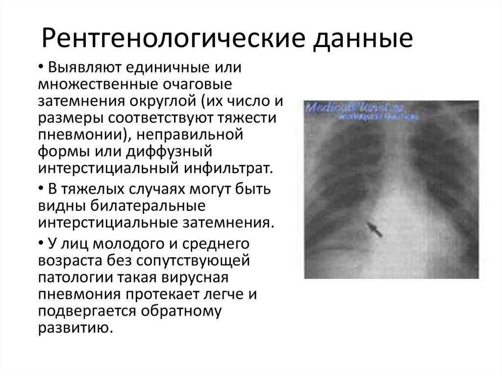 Вирусная пневмония симптомы. Вирусная пневмония рентген описание. Рентгенологическое описание очаговой пневмонии. Вирусная пневмония у детей рентген. Интерстициальная пневмония рентген описание.