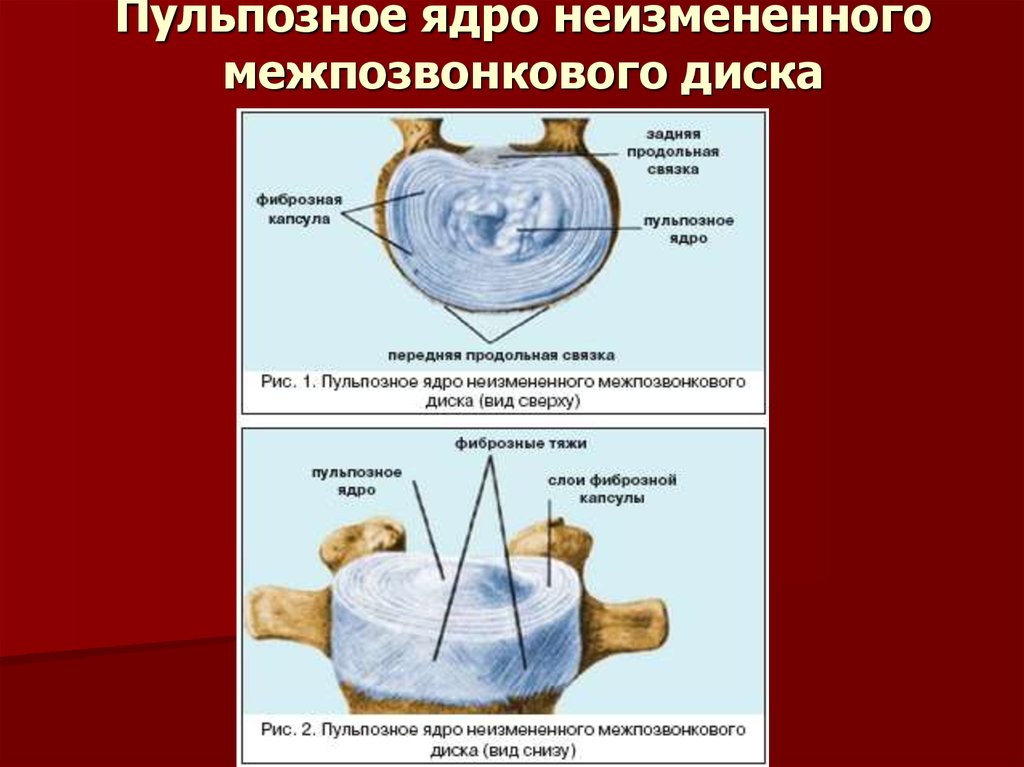 Операция по замене межпозвоночного диска