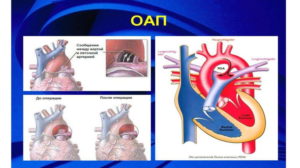 Открытый артериальный проток у детей презентация