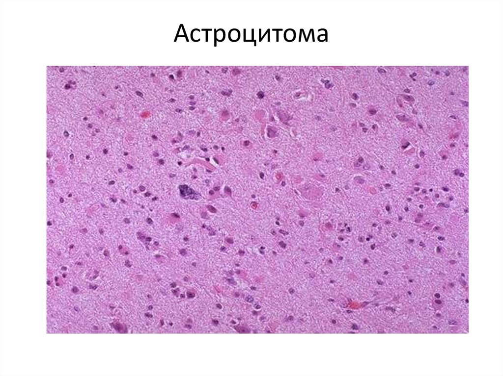 Глиобластома микропрепарат рисунок