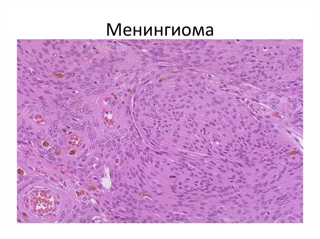 Глиобластома микропрепарат рисунок