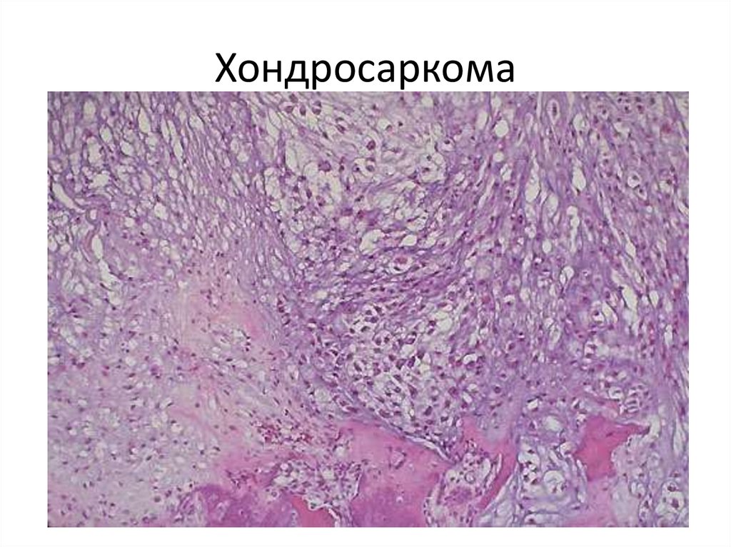 Хондрома микропрепарат рисунок