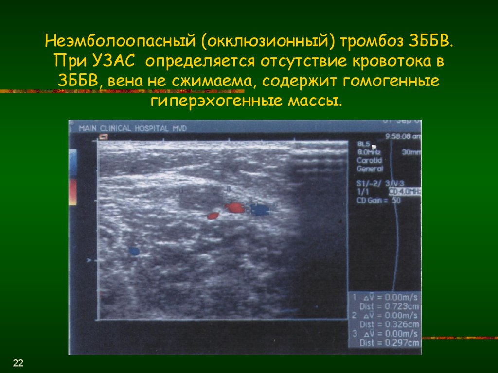 Тромбоз суральных вен