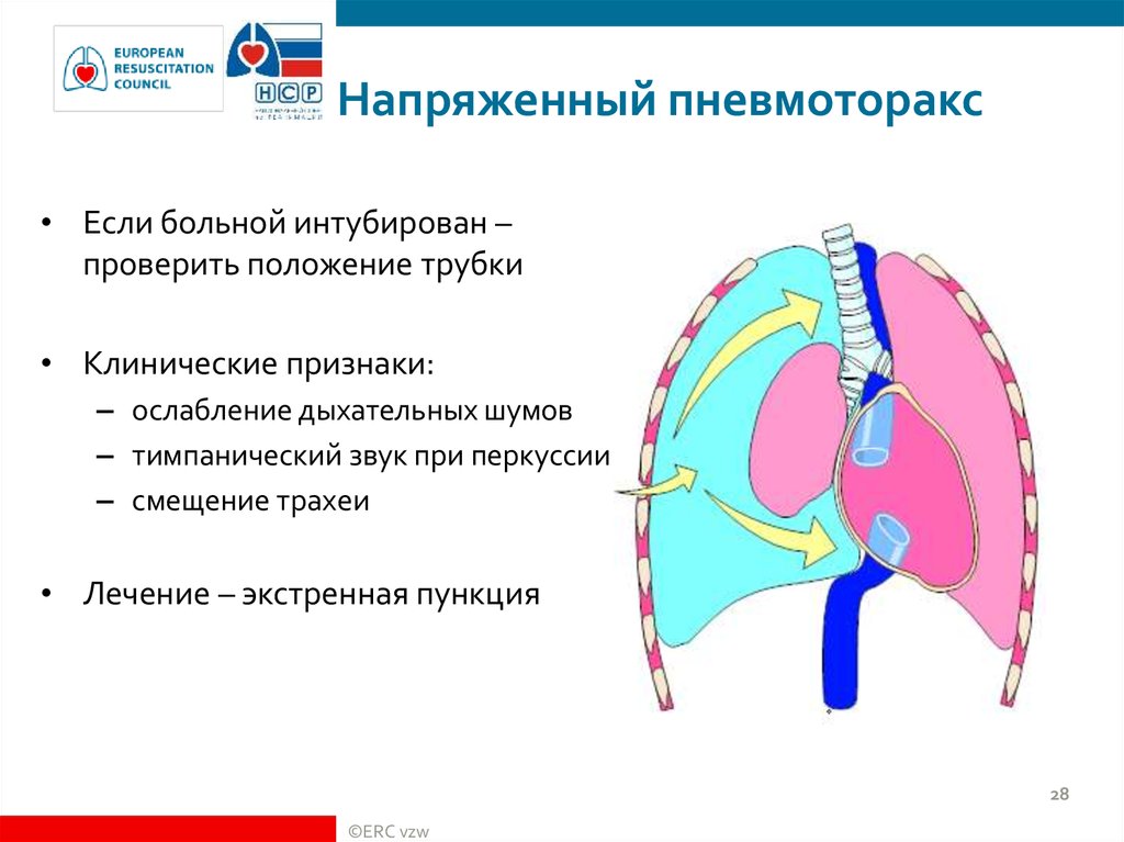 Напряженный пневмоторакс. Напряженный пневмоторакс дыхательная недостаточность. Пневмоторакс основной дыхательный шум. Ятрогенный пневмоторакс. Пневмоторакс клиническая картина.