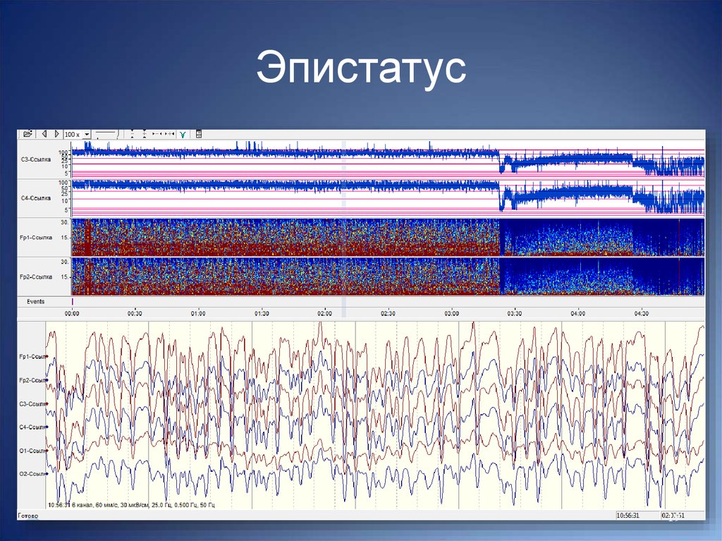 Эпи. Эпистатус. ЭЭГ при эпистатусе. Нейрофизиологический мониторинг головного мозга. ЭЭГ мониторинг у животных.