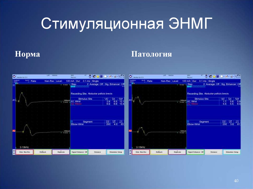 Энмг. Электронейромиография нормы. Стимуляционная электронейромиография норма. Стимуляционная электромиография. Стимуляционная (поверхностная) электромиография.