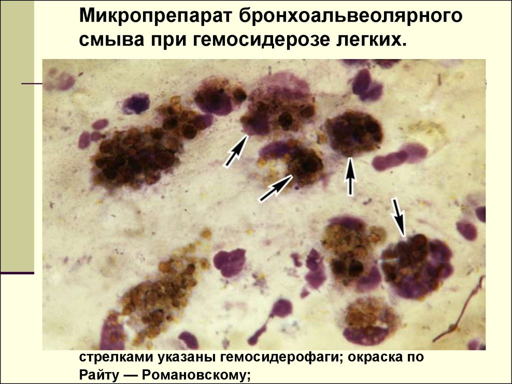 Железо в макрофагах. Гемосидероз альвеолярных макрофагов. Гемосидероз легких макропрепарат. Гемосидерофаги микропрепарат. Гематоидин и гемосидерин.