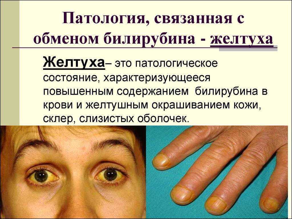 Можно ли по состоянию кожных покровов человека. Повышенный билирубин симптомы. Симптомы при высоком билирубине. Желтушность кожных покровов и слизистых.
