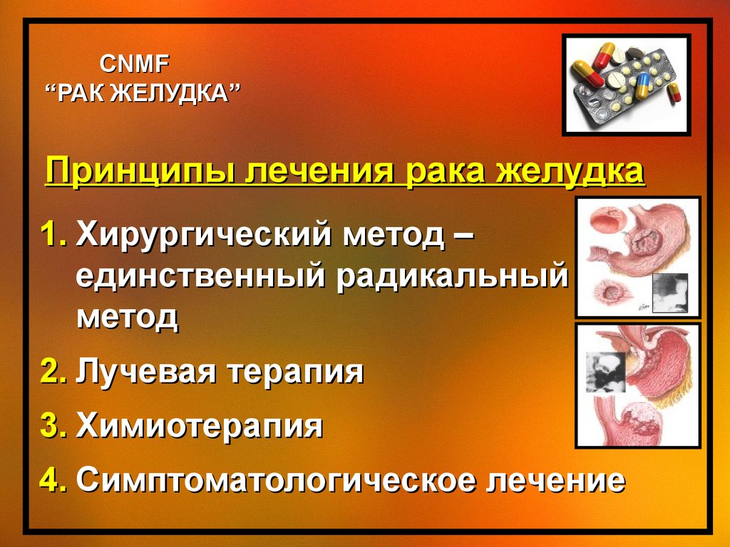 Рак желудка презентация по хирургии