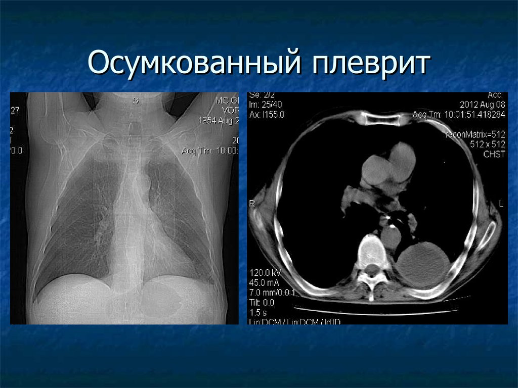 Гидроторакс на кт. Осумкованный экссудативный плеврит рентген. Междолевой плеврит на кт. Осумкованный междолевой плеврит на кт. Осумкованный гидроторакс кт.