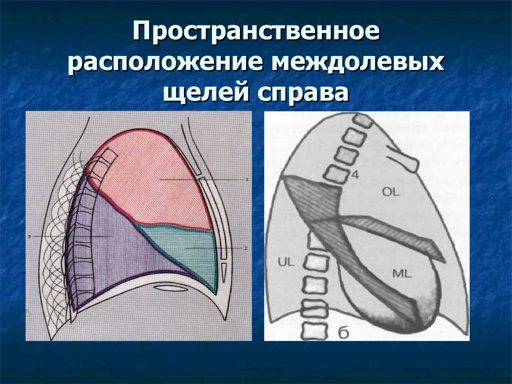 Пространственное расположение. Междолевая щель. Горизонтальная междолевая щель. Косая междолевая плевра. Междолевая плевра справа.