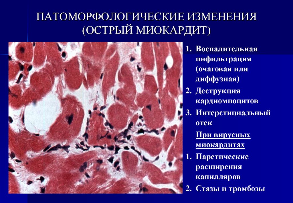 Острый миокардит презентация