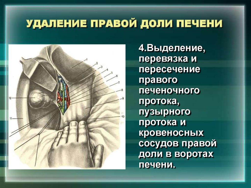 Печень право доли. Резекция правой доли печени. Доли правой доли печени. Резекция левой доли печени. Удалили правую долю печени.