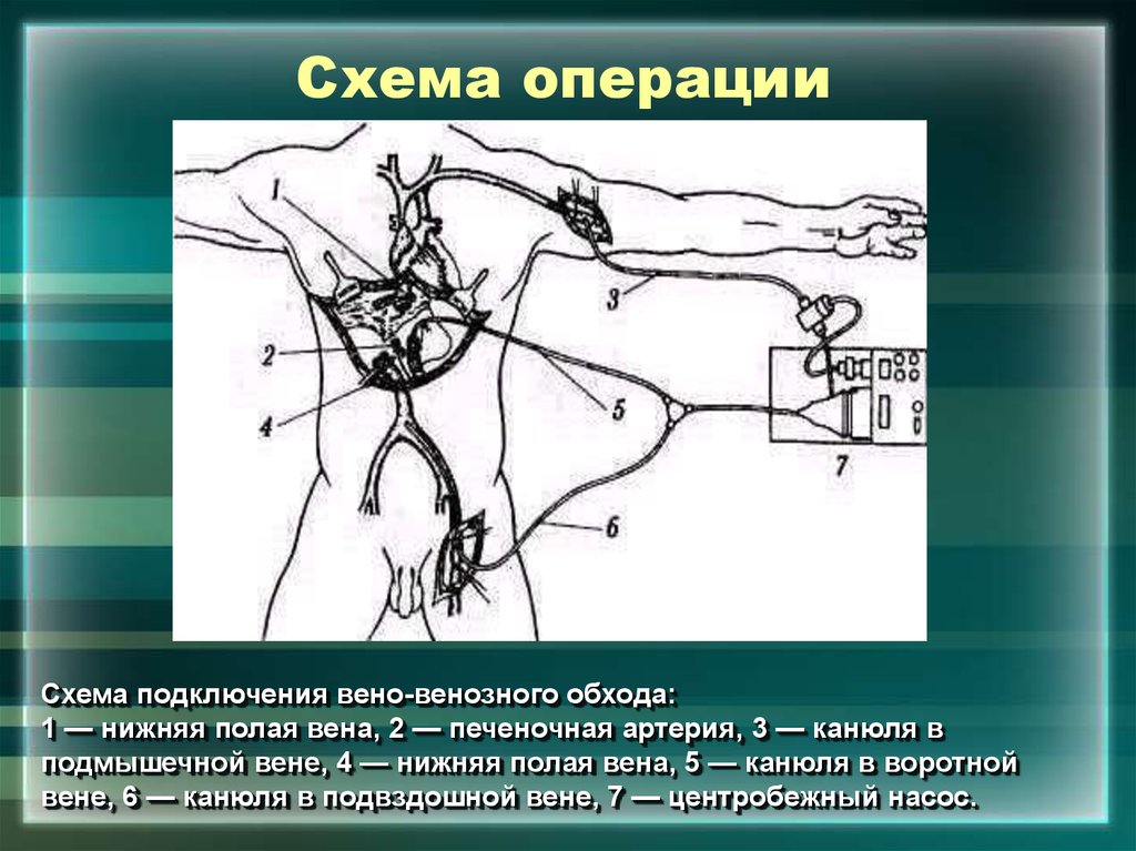 Схема перекопской операции