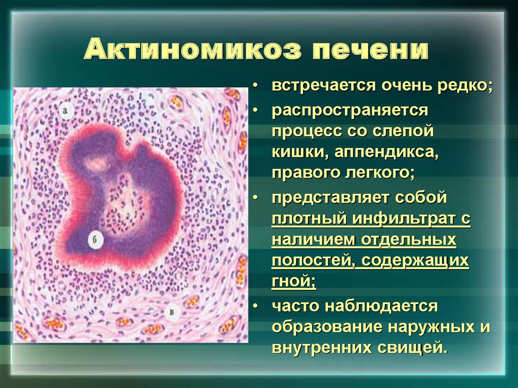 Флегмона препарат