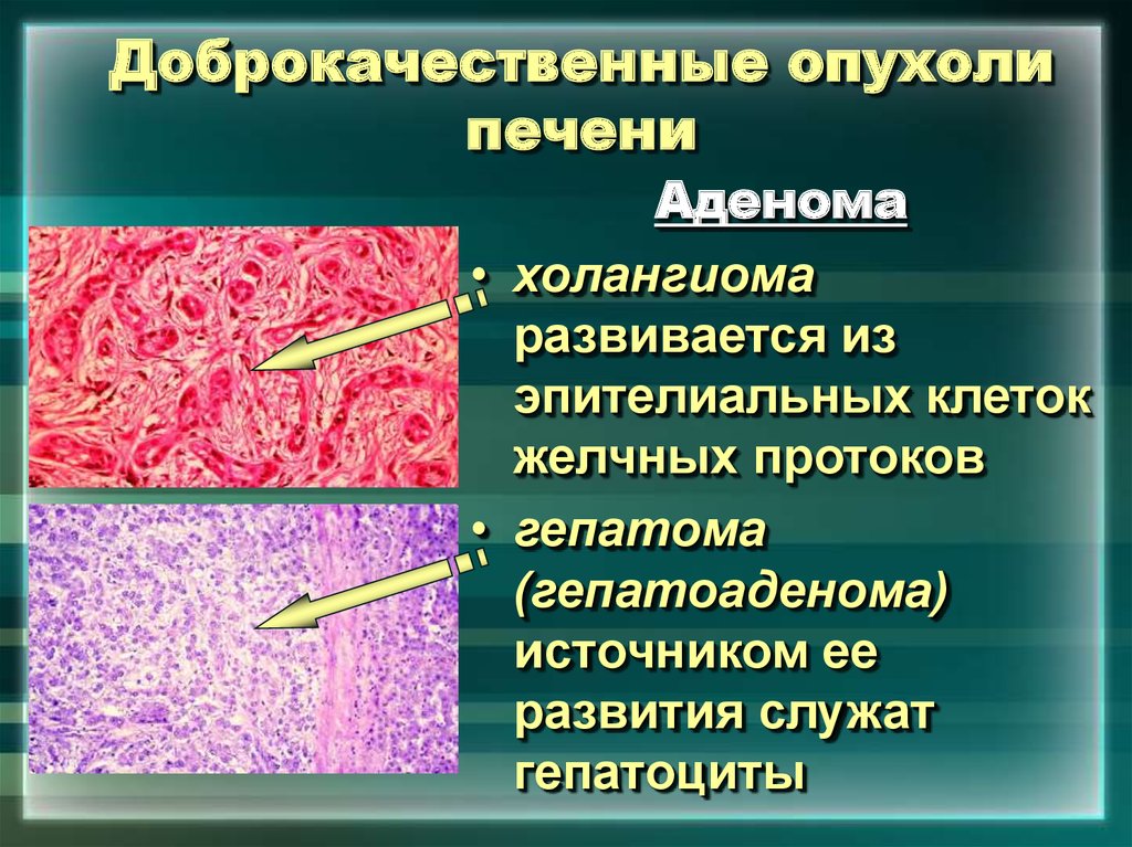 Доброкачественные опухоли презентация. Печеночно клеточная аденома гистология. Гепатоцеллюлярная карцинома гистология. Доброкачественные опухоли печени.