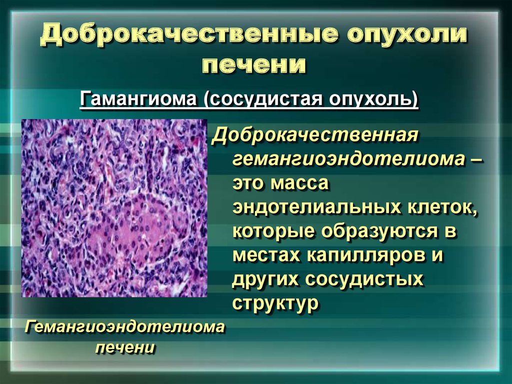 Злокачественный характер. Доброкачественная опухоль. Клетки, образующие доброкачественную опухоль:. Доброкачественные и злокачественные опухоли печени. Злокачественные опухоли печени классификация.