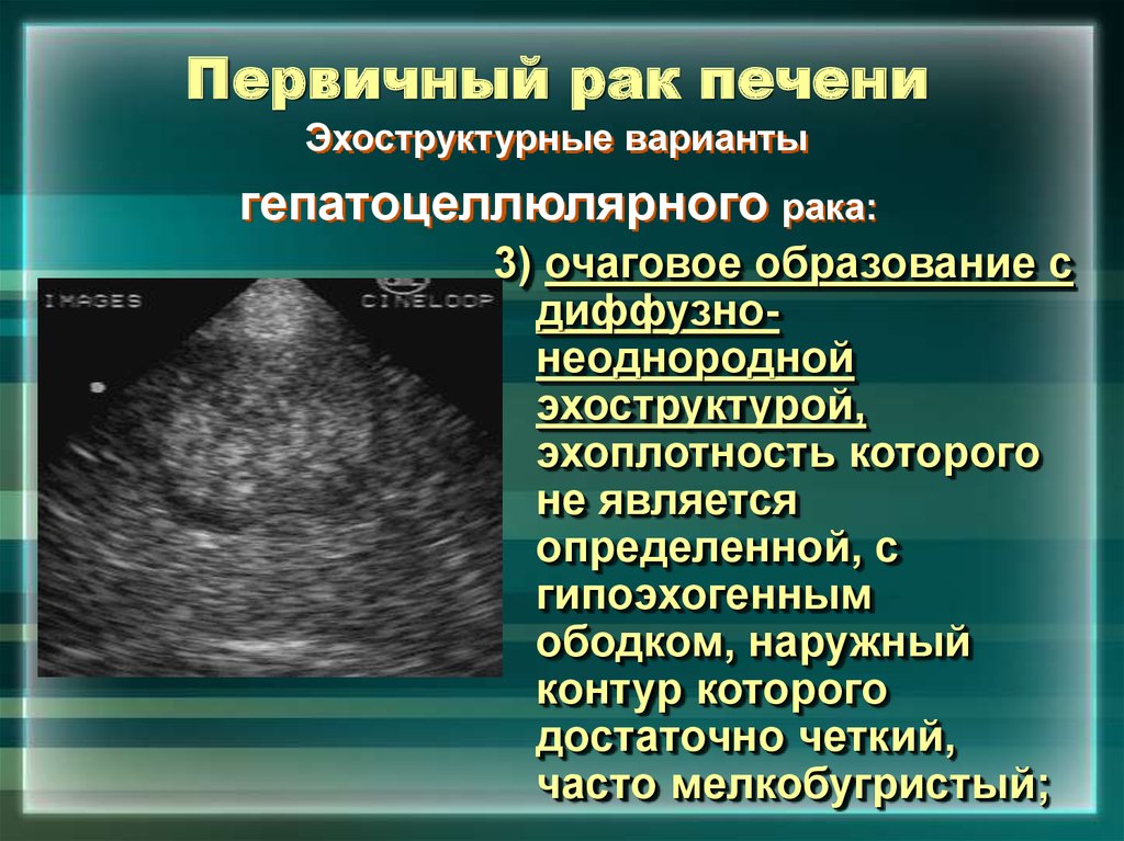 Стадии рака печени. Первичные злокачественные опухоли печени. Очаговое образование печени. Онкология печени признаки. Опухоль печени симптомы.