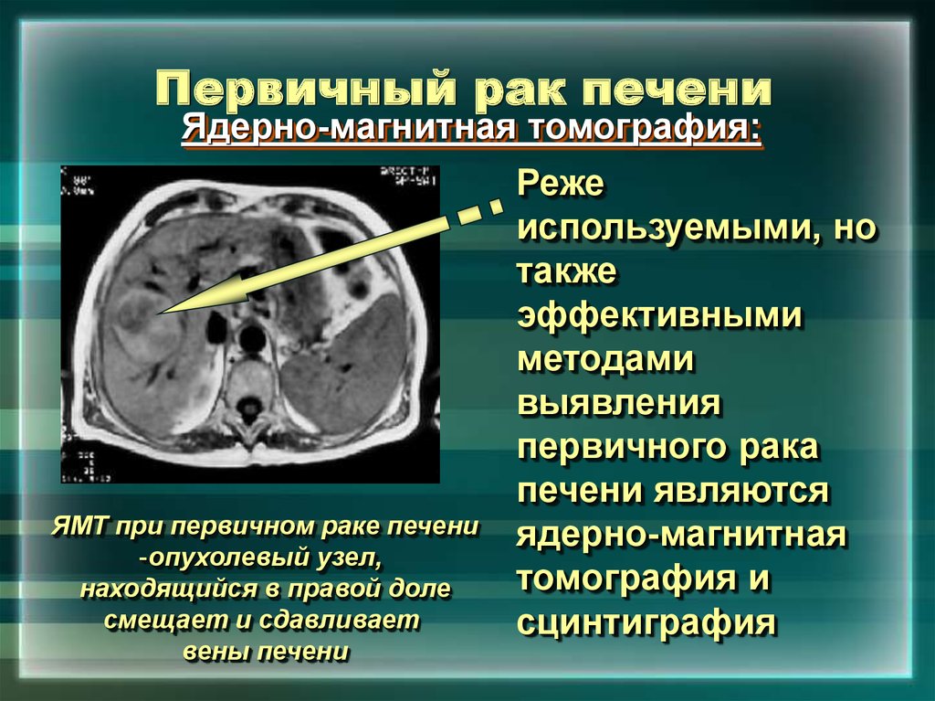 Рак печени 4 стадии сколько живут