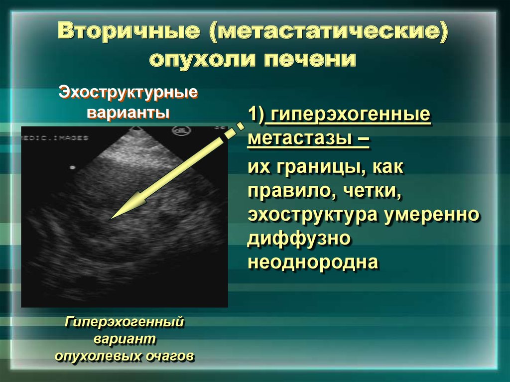 Эхографическая картина первичного рака печени характеризуется тест