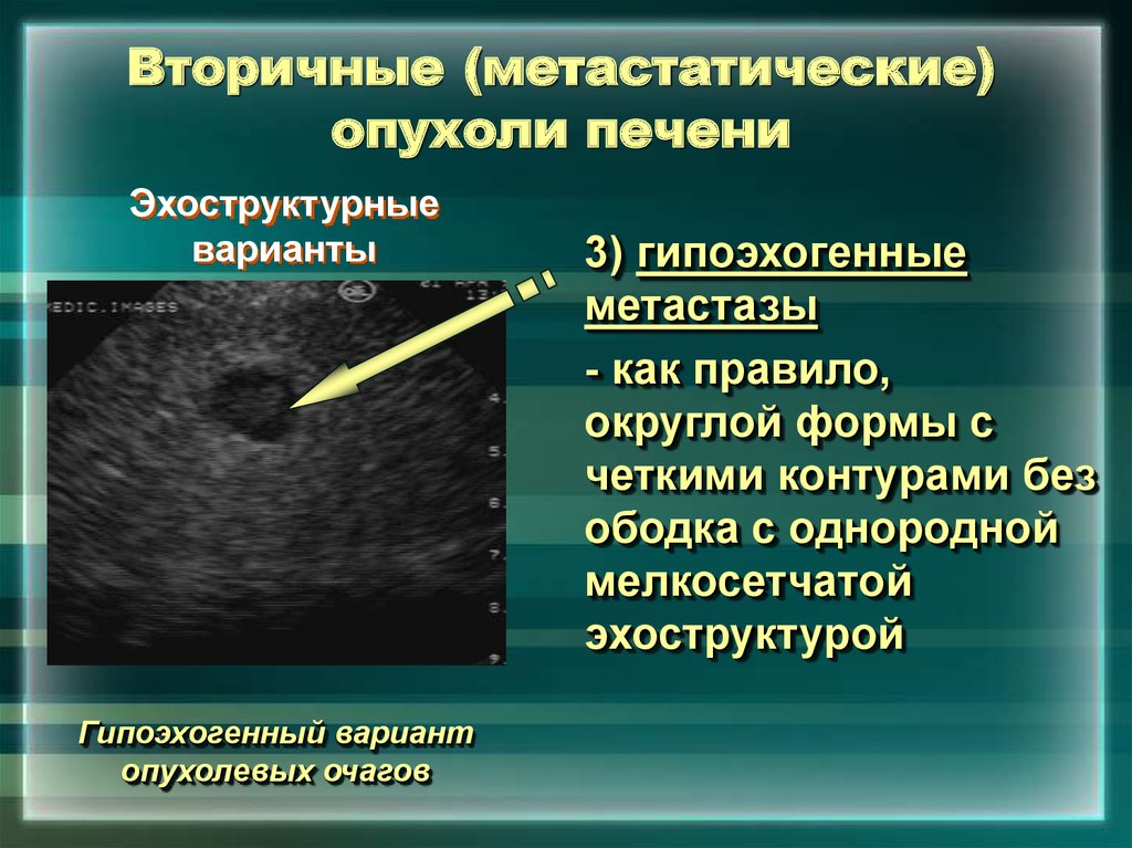 Очаговое образование печени. Новообразование в печени на УЗИ. Доброкачественная опухоль печени на УЗИ. Объемное образование печени. Доброкачественные новообразования печени.