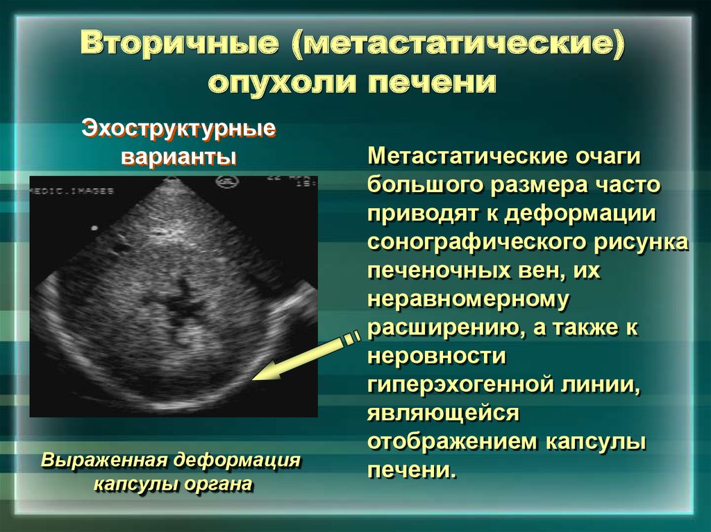 Доброкачественные опухоли печени презентация