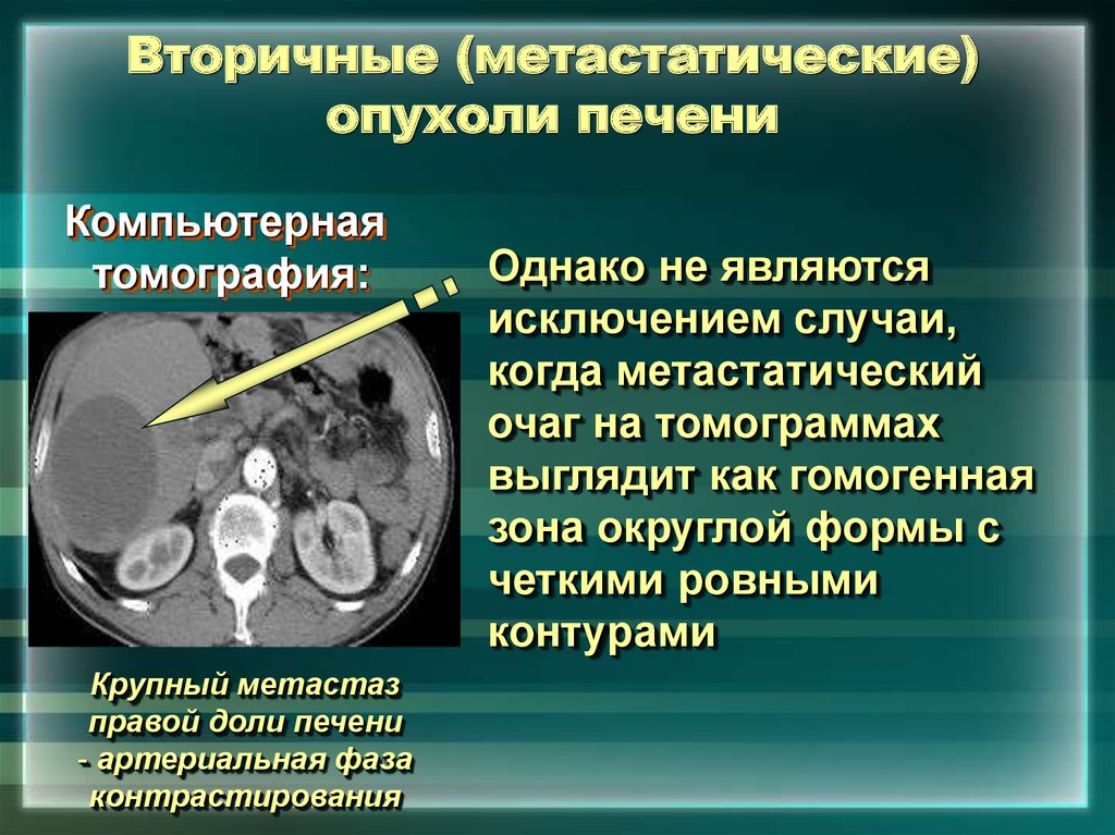 Вторичное поражение. Вторичные (Метастатические) опухоли печени. Объемное образование печени. Объемные образования печени на кт.