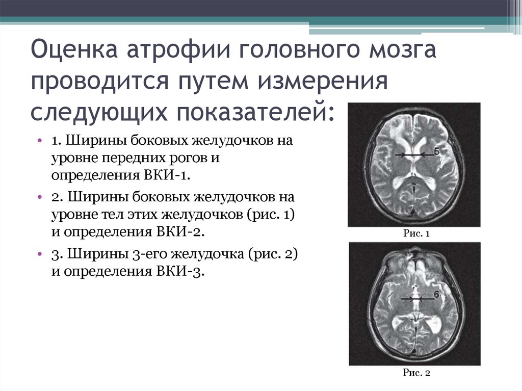 Признаки атрофии головного мозга. Мрт головного мозга кортикальная церебральная атрофия 1 степени. Кт признаки атрофии головного мозга. Кт признаки церебральной атрофии. Умеренные атрофические изменения головного мозга.